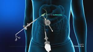 Gallbladder Surgery